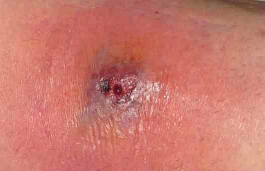 spider bites symptoms and pictures. Spider Bites amp; The Symptoms;